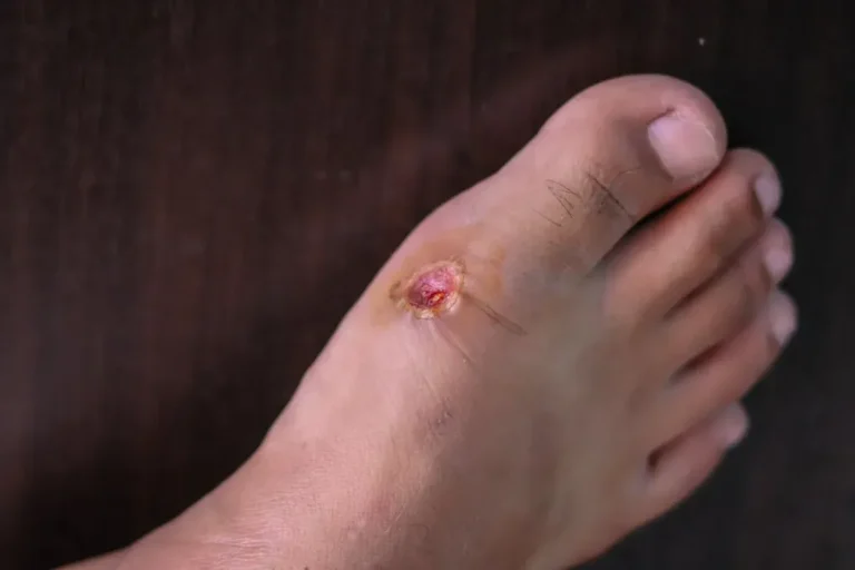 The Importance of Diabetic Wound and Foot Care