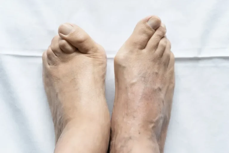 5 Things We Want You to Know About Hammertoes